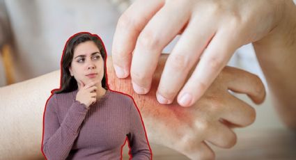 Viruela símica: ¿Cuántos casos se registran en Yucatán?