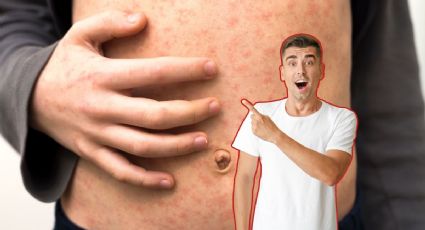 ¿Cuántos casos de sarampión se registran hasta hoy, 1 de julio, en Yucatán?