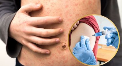 Sarampión en Yucatán: ¿cuáles son las vacunas que se están aplicando en el estado?