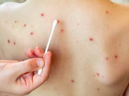 Síntomas y signos que tienes que conocer para identificar el Sarampión en niños