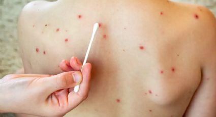 Síntomas y signos que tienes que conocer para identificar el Sarampión en niños