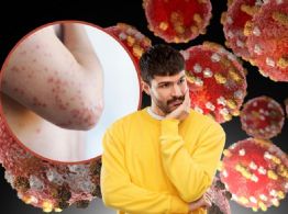 ¿Qué es el sarampión? Síntomas, a quiénes le da y todo lo que debes saber para prevenir contagios