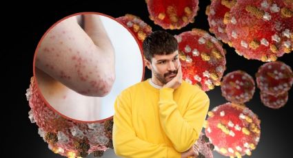 ¿Qué es el sarampión? Síntomas, a quiénes le da y todo lo que debes saber para prevenir contagios