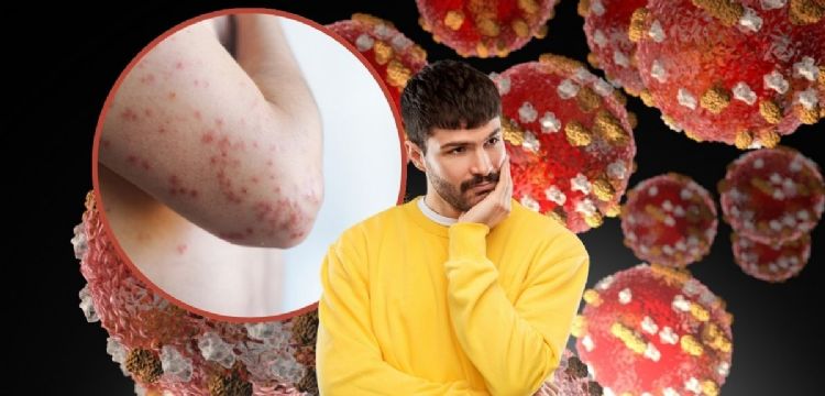 ¿Qué es el sarampión? Síntomas, a quiénes le da y todo lo que debes saber para prevenir contagios