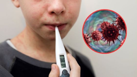 Síntomas del sarampión: ¿cuáles son según las etapas de la enfermedad?