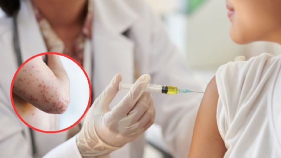 Sarampión en Yucatán: ¿Cómo puedes saber si tienes el esquema de vacunación completo?