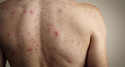 Regresa el Sarampión a Yucatán: autoridades reportan 90 nuevos posibles contagios