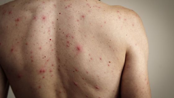 Regresa el Sarampión a Yucatán: autoridades reportan 90 nuevos posibles contagios