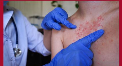 Sarampión en Yucatán: suman 17 casos confirmados en 5 municipios y refuerzan llamado a vacunarse