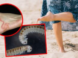 Alerta en playas de Yucatán por posible presencia de larva migrans cutánea: síntomas y cómo prevenir