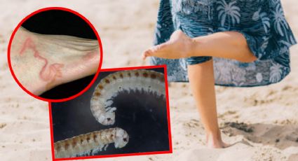 Alerta en playas de Yucatán por posible presencia de larva migrans cutánea: síntomas y cómo prevenir